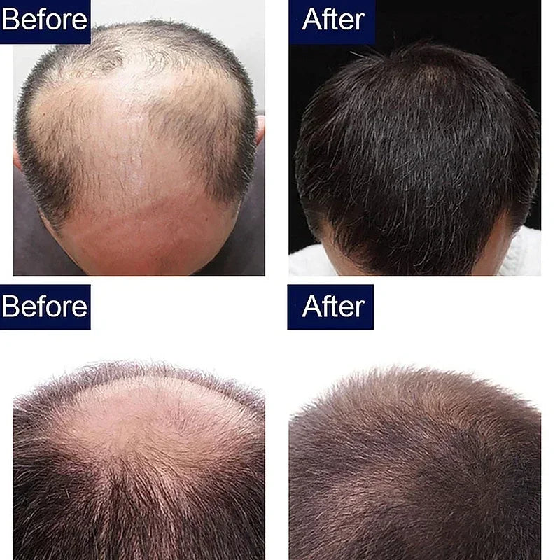 Anti Hair Loss Men Women Scalp Treatment Serum